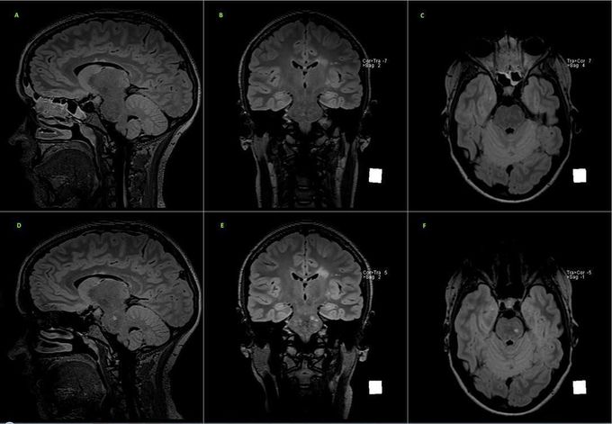 MRI is very useful at the follow-up step, in patients with established MS