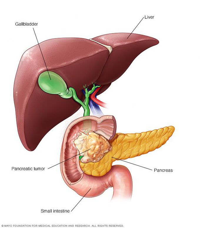 Causes of pancreatic tumor