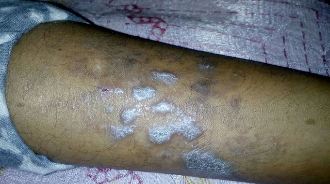 Hllo guess  what is this is it .any solution. It is not a birth mark..any medicine?????..