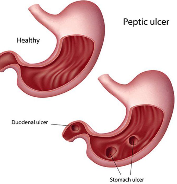 Duodenal Ulcer