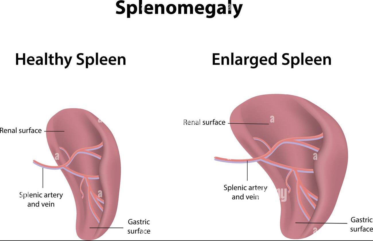 Splenomegaly Medizzy