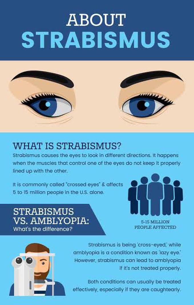 Strabismus causes