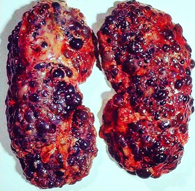 Polycystic kidney disease (PKD)