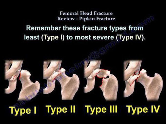 Fractures of the femoral head-Pipkin fracture