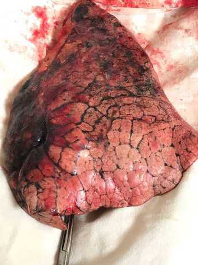 Lung cancer
