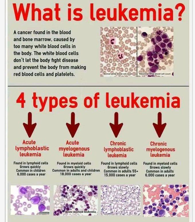 leukemia-medizzy