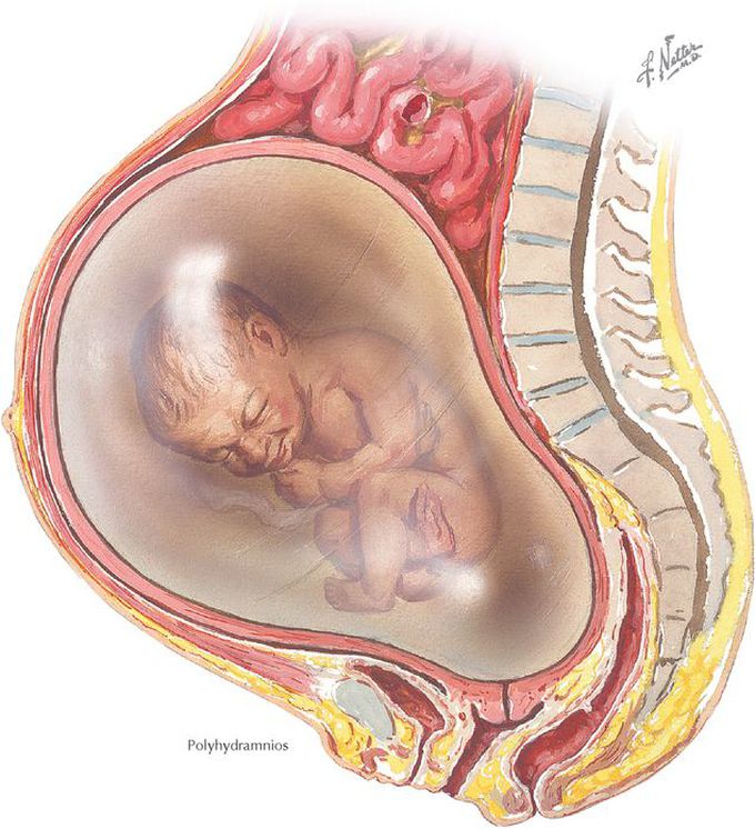 Causes of Polyhydramnios