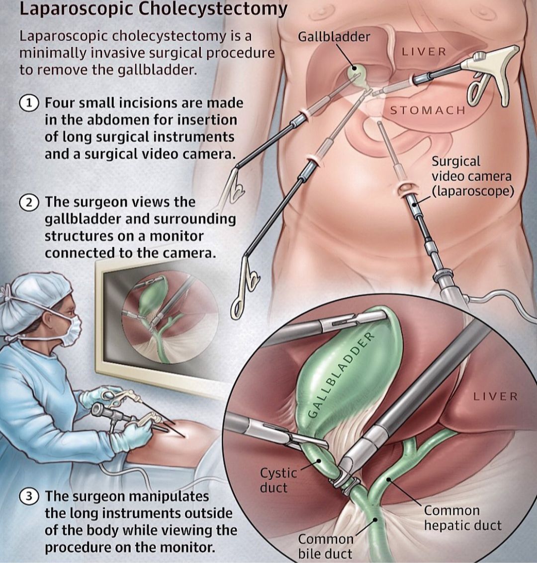 Желчный пузырь удаление сколько. Холецистэктомия анатомия. Холецистэктомия желчного пузыря. Холецистэктомия ход операции. Лапароскопическая холецистэктомия этапы операции.