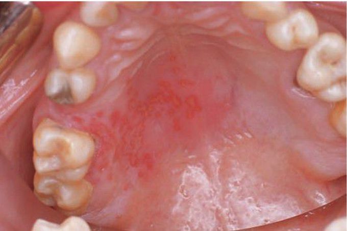 Secondary herpes infection of palate