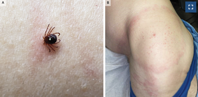 Southern Tick-Associated Rash Illness