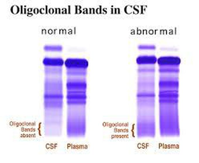 Oligoclonal bands (electrophoresis)