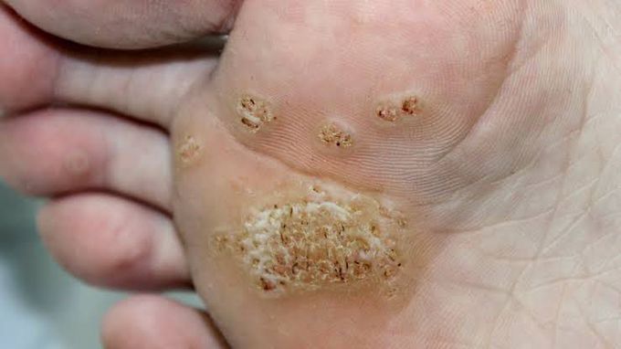 Treatment of warts