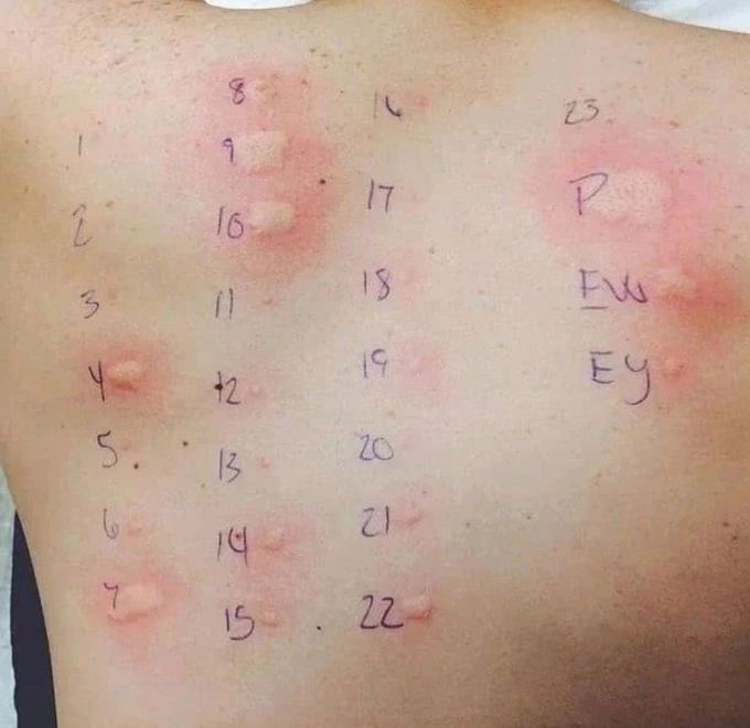 Skin Allergy Testing