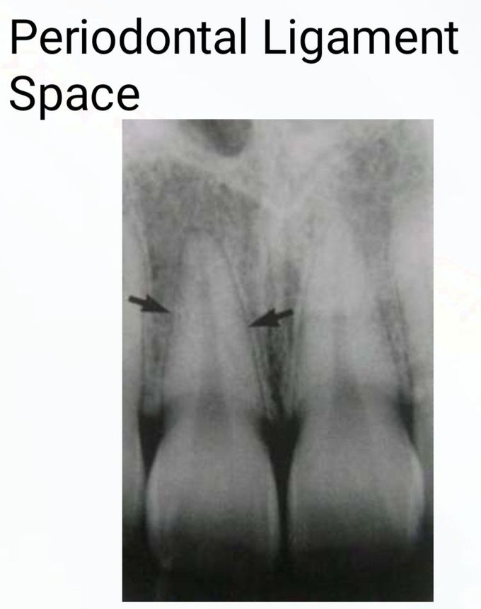 Periodontal Ligament Space