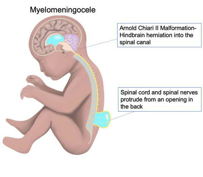 Treatment of myelomeningocele