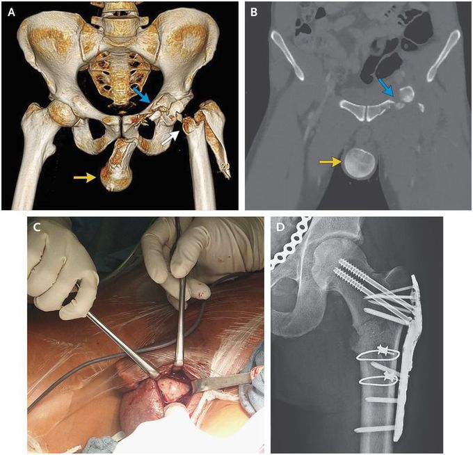 Femoral-Head Dislocation to the Scrotum