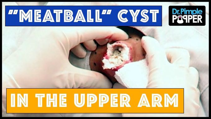 A huge cyst like a DOORKNOB: Hard boiled eggs, anyone?
