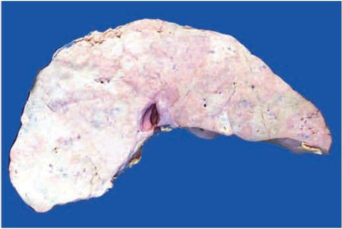 Metastatic tumour deposits in the liver