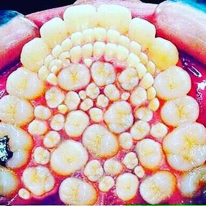 Complex Odontoma