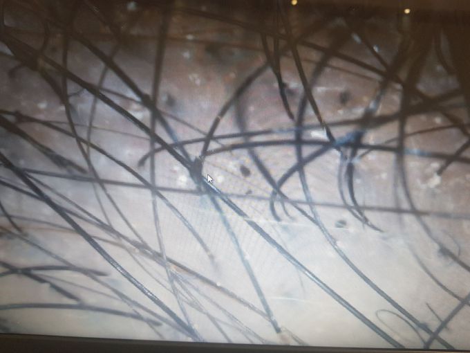 Baby anage hair loss