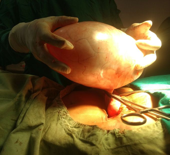 Ovarian cyst
