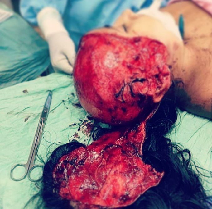 Unfortunate accident led to scalp avulsion 😔💡