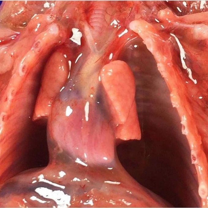 Pulmonary hypoplasia