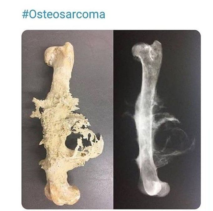 Osteosarcoma