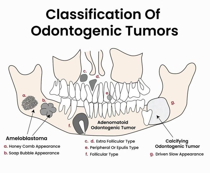 Classification of Odontogenic Tumors