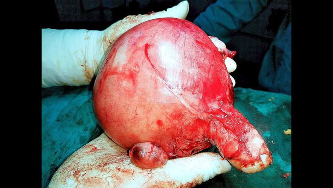 Huge Fibroid Uterus: Total Abdominal Hysterectomy with Bilateral Salpingo-oophorectomy