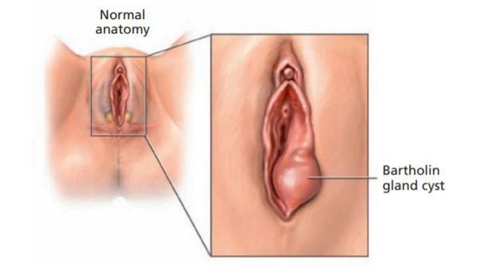 What are the symptoms of vaginal cysts?