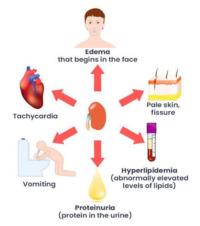 Symptoms of nephrotic syndrome - MEDizzy