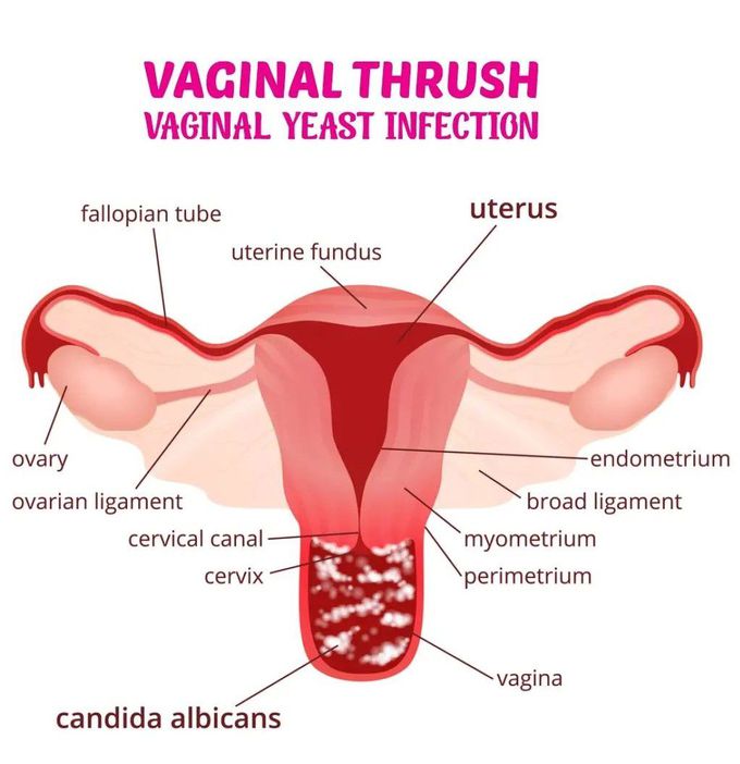 Vaginal Thrush