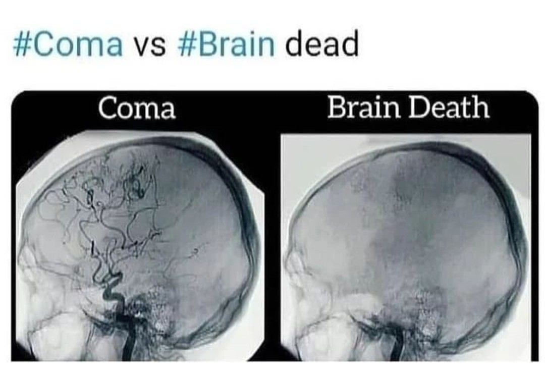 Brain Dead