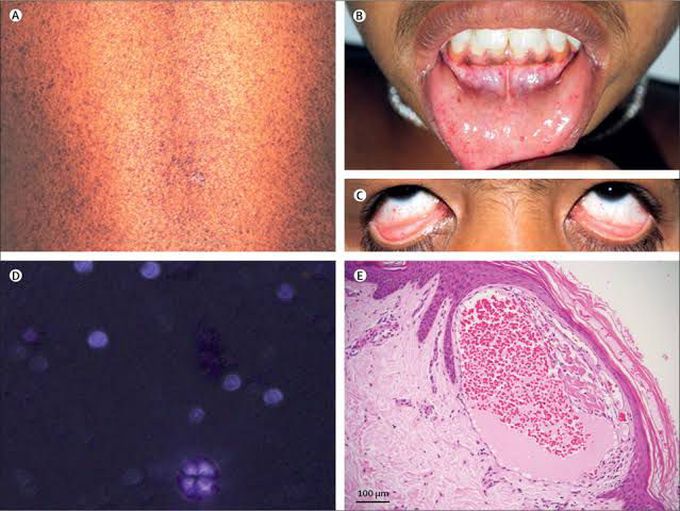 Causes of fabrys disease