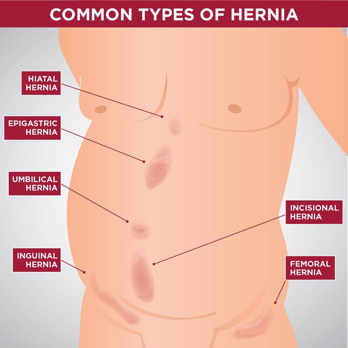Comman types of hernia