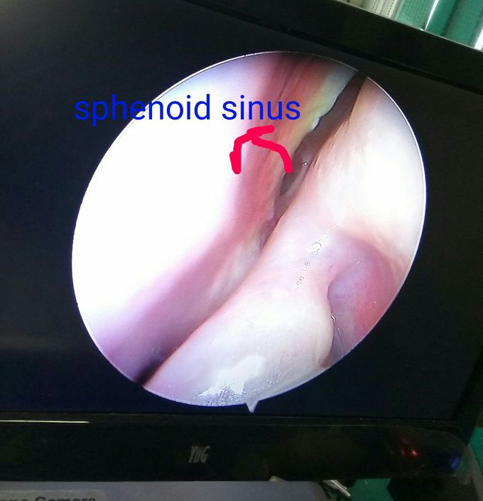 Sphenoid siNus