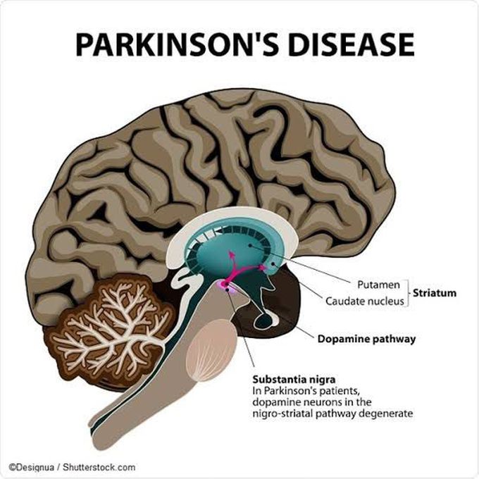 Treatment of parkinson's disease