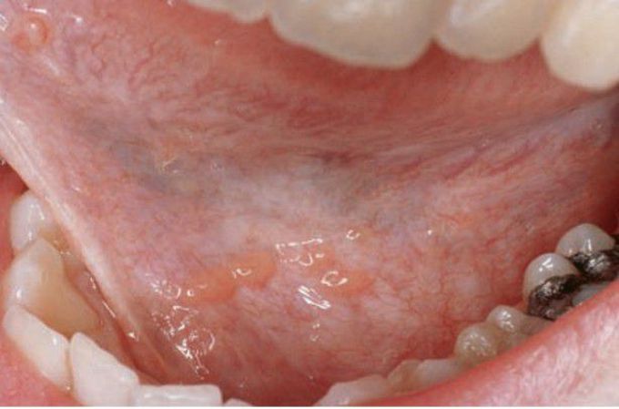 Ectopic lymphoid tissue in floor of mouth