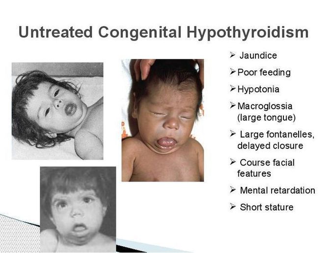 Hypothyroidism in infants