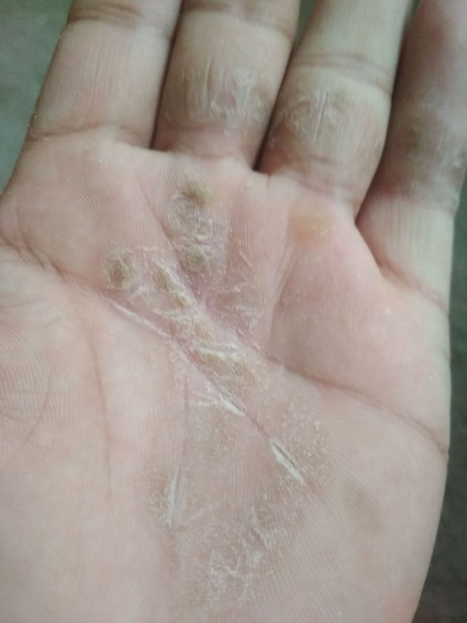 What's disease is this and treatment??????