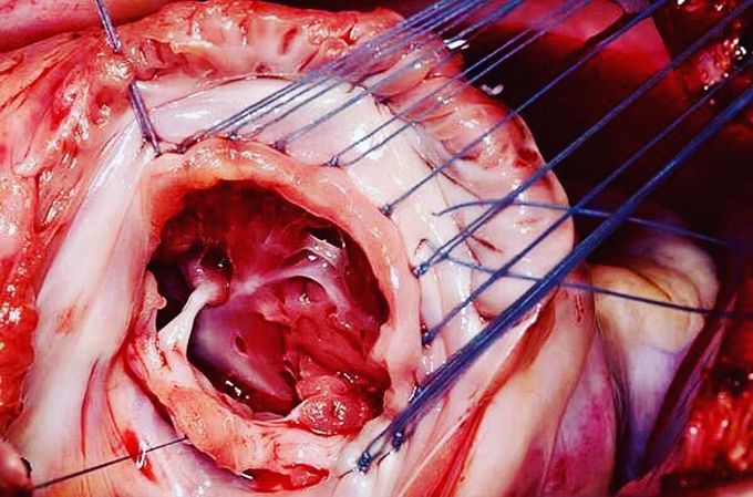 Tricuspic valve, The Heart ❤️