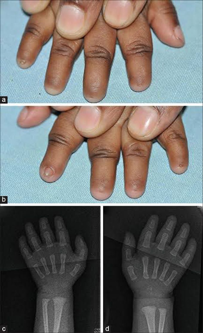 Anonychia with absent phalanges and brachydactyly