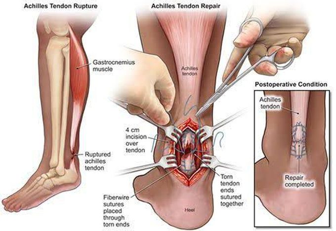 Management of ruptured achilles tendon