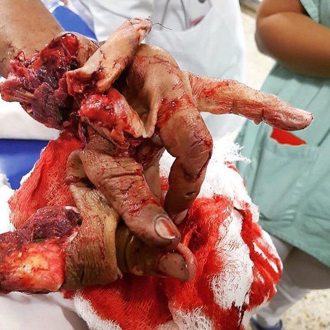 Hand injury