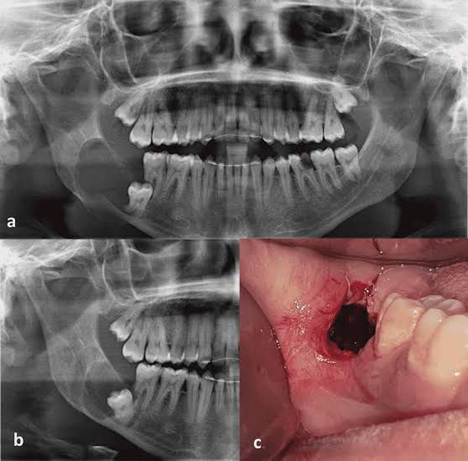 Dentigerous cyst