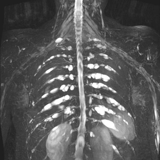 Neurofibromatosis