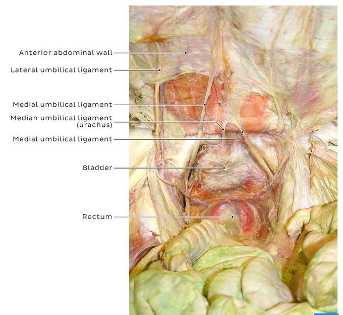 Photograph of cadaver dissection showing the umbilical structures on a view of a partially reflected anterior abdominal wall.