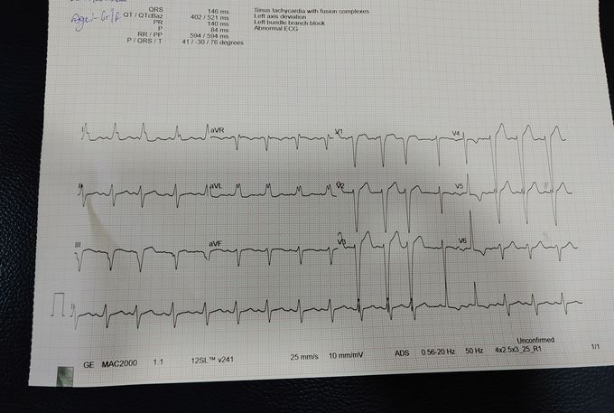 A old women came to hospital with severe chest pain past history ;while walking or doing work she is feeling chest pain ecg is abnormal ;ultrasound is alao abnormal sinus trachycardia