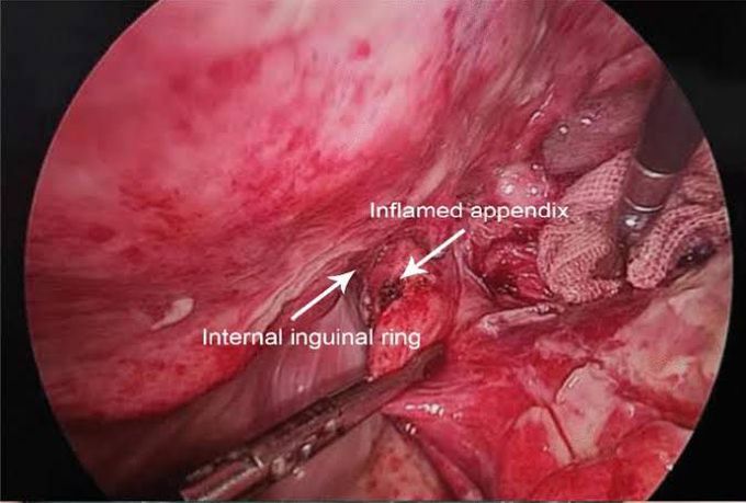 Amyand's hernia